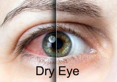 Close-up of a human eye showing dry eye symptoms.